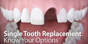 Single Tooth Replacement Illustration