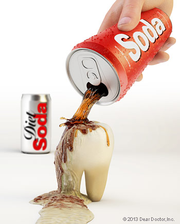 An illustration on soda causing tooth erosion