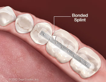 Bonded Splint in Teeth
