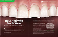 Teeth Wear Article from Dear Doctor