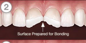 Illustration of Tooth Bonding
