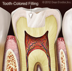 Tooth Colored Fillings Illustration Dear Doctor