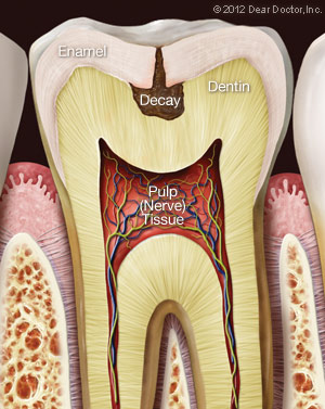 Tooth Decay Illustration