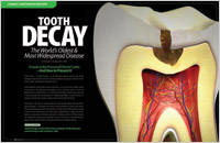 An article on tooth decay as a preventable disease from Dear Doctor Magazine