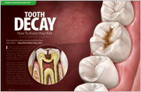 An article on assessing tooth decay risk from Dear Doctor magazine