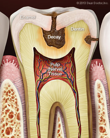 Illustration of Tooth Decay and Sensitive Teeth