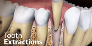 Tooth Extraction Illustration CenterCare Dental Group