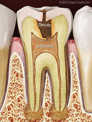 Tooth Infection Illustration