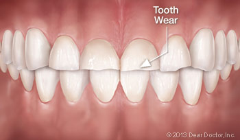 An illustration of tooth wear