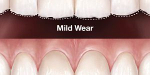 Mild and moderate tooth wear illustration