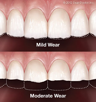 Mild and moderate tooth wear illustration