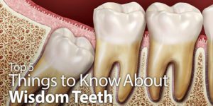 Things to Know About Wisdom Teeth Illustration
