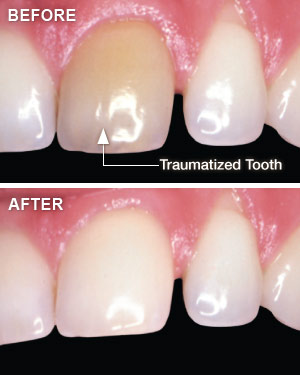 Before and after whitening of traumatized teeth