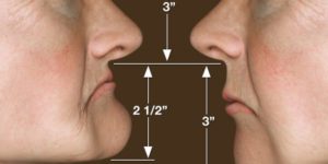 Restoring Facial Contours with Dentures